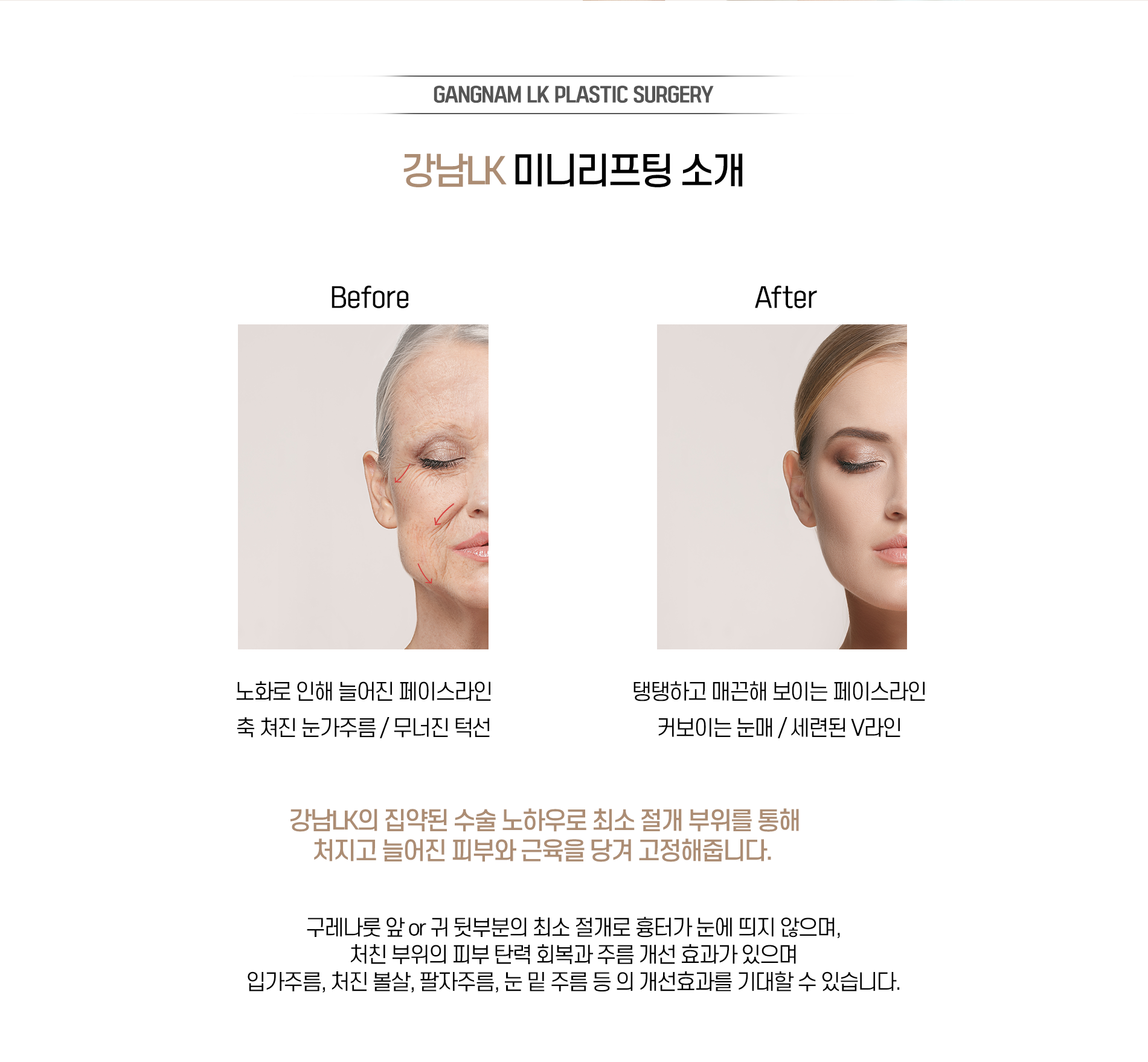 미니리프팅