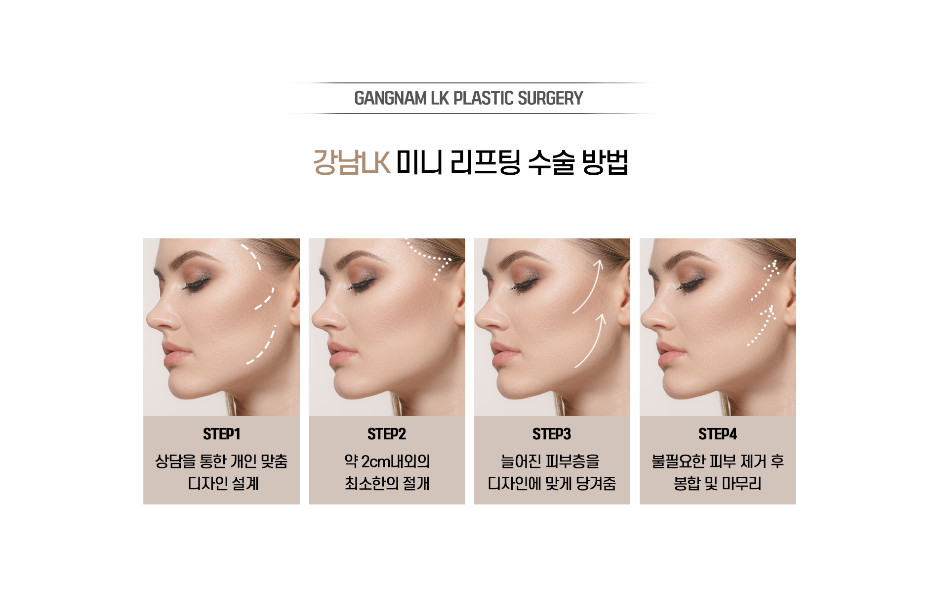 미니리프팅